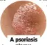  ?? ?? A psoriasis plaque