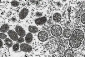  ?? CDC VIA AP ?? Mature, oval-shaped monkeypox virions (left) and spherical immature virions (right) obtained from a sample of human skin associated with a 2003 prairie dog outbreak. On Wednesday, Portuguese health authoritie­s confirmed five cases of monkeypox, marking an unusual outbreak in Europe of a disease typically limited to Africa.