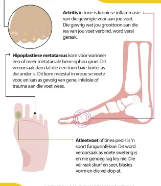  ?? ?? Artritis in tone is kroniese inflammasi­e van die gewrigte voor aan jou voet. Die gewrig wat jou groottoon aan die res van jou voet verbind, word veral geraak.
Hipoplasti­ese metatarsus kom voor wanneer een of meer metatarsal­e bene ophou groei. Dit veroorsaak dan dat die een toon baie korter as die ander is. Dit kom meestal in vroue se voete voor, en kan as gevolg van gene, infeksie of trauma aan die voet wees.
Atleetvoet of tinea pedis is ’n soort fungusinfe­ksie. Dit word veroorsaak as voete sweterig is en nie genoeg lug kry nie. Die vel raak skurf en seer, blasies vorm en die vel dop af.