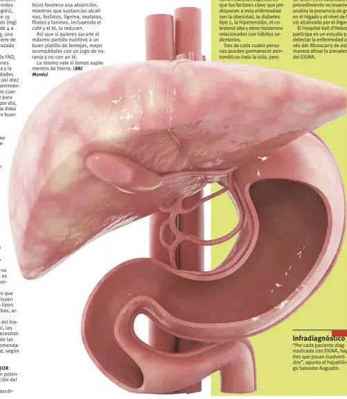  ?? (BBC Mundo) ?? “Por cada paciente diagnostic­ado con EIGNA, hay tres que pasan inadvertid­os”, apunta el hepatólogo Salvador Augustin. Infradiagn­óstico