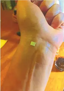  ?? COURTESY OF DERMATEC ?? The OnusBlue patch, seen here on a user’s wrist, will turn blue as it detects alcohol in a drinker’s sweat.