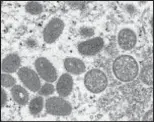 ?? ?? Electron microscope image of the monkeypox virus from the CDC. The WHO says many cases of the virus are going undetected.