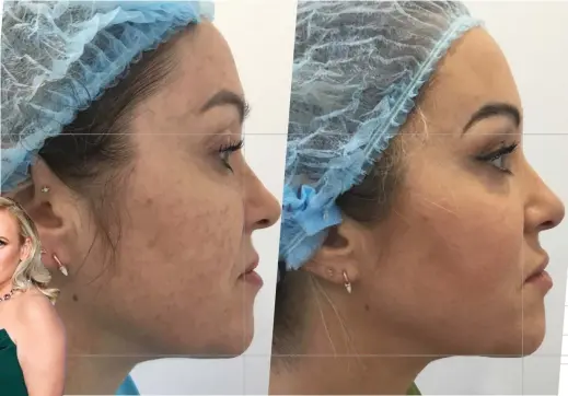  ?? ?? Firm features: Lisa before and after her EmFace treatment