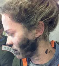  ?? — AFP ?? The woman after she suffered burns to her face and hands when her headphones caught fire during a flight to Australia.