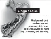  ??  ?? Clogged Colon