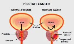  ??  ?? This 3D illustrati­on shows normal prostate gland and the presence of a tumour inside the prostate gland which compresses the urethra.