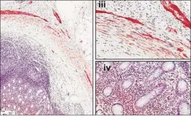  ?? B.A. Killinger et al. Science Translatio­nal Medicine ?? HEALTHY APPENDIXES contain alpha-synuclein (shown in red), a protein that is a constituen­t of the Lewy bodies observed in Parkinson’s disease.