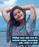  ?? ?? Vitiligo sees skin lose its natural colour, becoming pale, white or pink