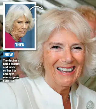  ?? ?? NOW
THEN
The duchess had a facelift and work on her lips and eyes, one surgeon surmises