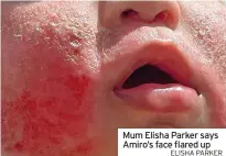  ?? ELISHA PARKER ?? Mum Elisha Parker says Amiro’s face flared up