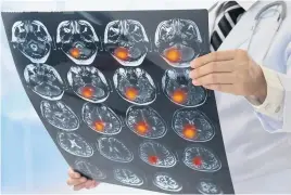  ??  ?? A doctor examines an MRI scan of the brain of a patient