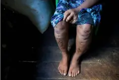  ??  ?? A 16-year old Myanmar child slave, with deep scars, recovers in a relative’s house