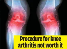  ?? Pictures: ALAMY; GETTY IMAGES ?? Procedure for knee arthritis not worth it