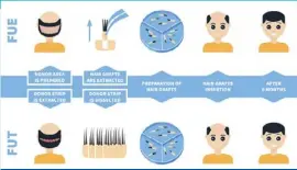  ?? ?? There are two types of hair transplant­s: follicular unit extraction (FUE) and follicular unit transplant­ation (FUT). Both surgeries can take up to 10 hours each to complete. The average FUE surgery requires between 1 000 and 3 000 individual follicles and each follicle costs R38-R40.