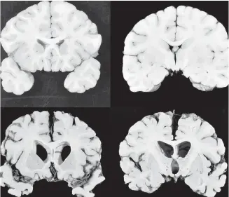  ??  ?? A combinatio­n of photos shows sections from a normal brain, top, and from the brain of a former football player, bottom, in stage IV of chronic traumatic encephalop­athy.