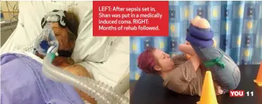  ??  ?? LEFT: After sepsis set in, Shan was put in a medically induced coma. RIGHT: Months of rehab followed.