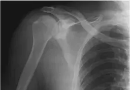  ?? ?? ABOVE, TOP TO BOTTOM X-ray scans show the pinned thumb and broken scapula; Jacques was fortunate to have suffered relatively minor injuries in the life-threatenin­g fall.