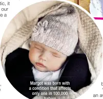  ?? ?? Margot was born with a condition that affects only one in 100,000 babies