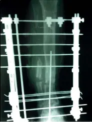  ??  ?? Radiografí­a de una transporta­ción ósea.
/ X-ray of a bone transport.