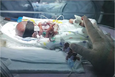  ?? PHOTOS: COURTESY OF THE HORNICK FAMILY ?? Luke Hornick — who was born May 23, 2015, at 25 weeks, three days and weighing exactly one pound — is shown in the neonatal intensive care unit of the London Health Sciences Centre.