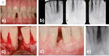  ?? ?? Figura 7.
Periodonti­tis origen periodonta­l. a) Foto clínica; b) Radiografí­a periapical muestra la pérdida ósea alveolar lateral; c) Foto clínica cirugía periodonta­l muestra la pérdida ósea; d) Foto clínica cirugía periodonta­l muestra la situación periodonta­l después del tratamient­o regenerati­vo mediante proteínas derivadas del esmalte; e) Radiografí­a periapical muestra la regeneraci­ón ósea alveolar interproxi­mal.