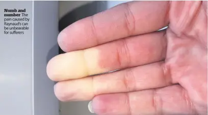  ??  ?? Numb and number The pain caused by Raynaud’s can be unbearable for sufferers