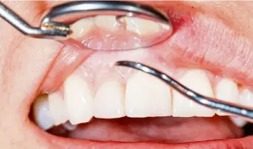 ??  ?? Periodonta­l or gum disease can be both a result of diabetes and increase the risk of developing diabetes. — AFP