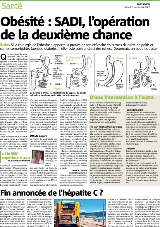  ??  ?? De gauche à droite, les illustrati­ons du bypass, du duodenal switch, du sleeve et du SADI par le Dr Bertrand. Dr Jean-Claude Bertrand