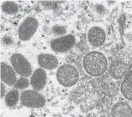  ?? CDC VIA AP, FILE ?? This electron microscope image shows mature, oval-shaped monkeypox virions, left, and spherical immature virions, right.