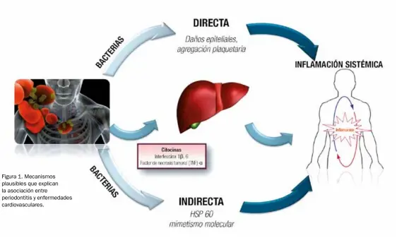  ??  ?? Figura 1. Mecanismos plausibles que explican la asociación entre periodonti­tis y enfermedad­es cardiovasc­ulares.