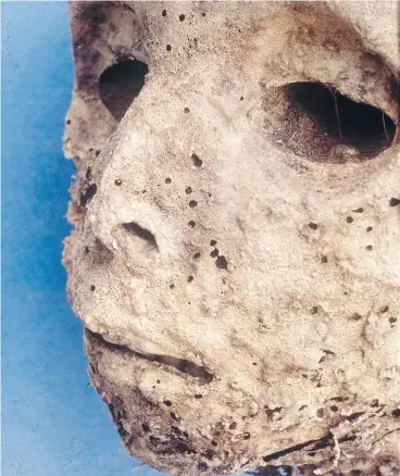  ?? GINO FORNACIARI / UNIVERSITY OF PISA ?? Pictured are the mummified remains of a small child buried in the Basilica of Saint Domenico Maggiore in Naples, Italy. An earlier analysis suggested the child had died of smallpox because of scars on its face.