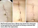  ??  ?? Ms Favell now has a 30cm scar from her sternum to her pelvis but was back to living a normal life soon after the operation