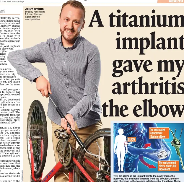 ??  ?? The articulate­d replacemen­t titanium elbow ELBOW The replacemen­t elbow allows full movement The 3in stems of the implant fit into the cavity inside the humerus, the arm bone that runs from the shoulder, and the ulna, the bone in the forearm, which meet...