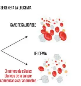  ??  ?? El número de células blancas de la sangre comienzan a ser anormales LEUCEMIA SANGRE SALUDABLE ASI SE GENERA LA LEUCEMIA