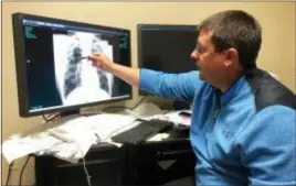  ?? DYLAN LOVAN — THE ASSOCIATED PRESS ?? Dr. Brandon Crum points to the X-ray of a black lung patient at his office in Pikeville, Ky., on Thursday. Crum has seen a wave of younger miners with black lung disease at his clinic since 2015.