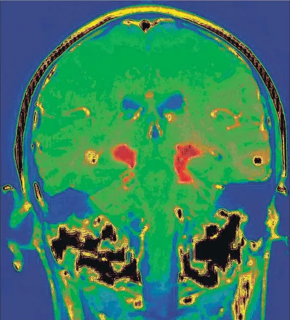  ?? BSIP / GETTY ?? Resonancia magnética del cerebro de una persona con parkinson; en rojo, la sustancia negra, donde se pierden neuronas que segregan dopamina