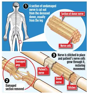  ??  ?? SENSATIONA­L: The procedure that restores movement to damaged limbs