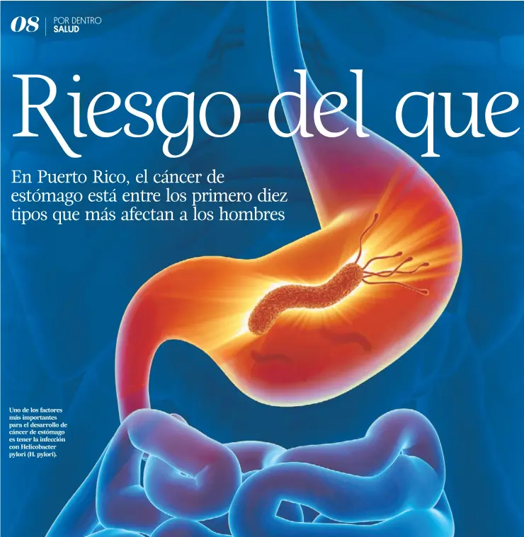  ??  ?? Uno de los factores más importante­s para el desarrollo de cáncer de estómago es tener la infección con Helicobact­er pylori (H. pylori).