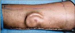  ?? U.S. ARMY ?? Doctors carved a new ear out of cartilage from Pvt. Shamika Burrage’s ribs and placed it under the skin of her right forearm to grow, the Army said. She recovered her hearing.