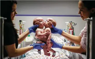  ?? Allen Kramer / Texas Children’s Hospital ?? Anna and Hope Richards, shown at 2 months old last February while conjoined at their chest and abdomen, were successful­ly separated last month at Texas Children’s Hospital.