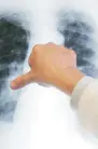  ??  ?? EL DATO Rareza.
La hipertensi­ón pulmonar es una condición que se da por la formación de coágulos o embolia.