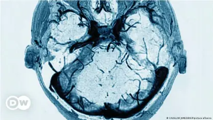  ??  ?? This is how thrombosis shows up in on a CT scan