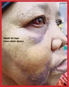  ??  ?? WAJAH Siti Hajar lebam akibat dipukul.