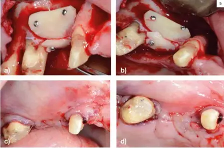  ??  ?? Figura 5. a) Imagen vestibular de las láminas autólogas fijadas. b) Imagen oclusal de las láminas autólogas fijadas. c) Imagen vestibular la sutura. d) Imagen oclusal de la sutura. 5