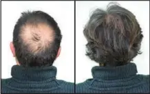  ?? ?? Breakthrou­gh research proves this discovery helps fill-in bald spots, re-nournishes thinning hair, and leads to noticeable growth in as little as 30 days.