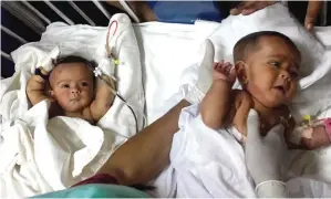  ?? — AFP ?? DHAKA: Previously-conjoined Bangladesh­i twins Tofa and Tahura are treated after surgery to separate them at Dhaka Medical College Hospital in Dhaka.