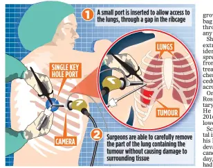  ??  ?? LESS INVASIVE: The new procedure is not as risky and cuts time in hospital