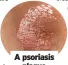  ?? ?? A psoriasis plaque