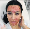  ??  ?? EXTREME MEASURES: Kim Kardashian posted a photo after undergoing a ‘vampire’ facial where a patient’s own blood is injected into their face to stimulate a youthful glow
