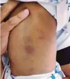  ?? PIC COURTESY OF POLICE ?? The bruises on the back of the 10-month-old girl.